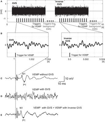 Effect of Noisy Galvanic Vestibular Stimulation on Ocular Vestibular-Evoked Myogenic Potentials to Bone-Conducted Vibration